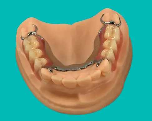 Frame Denture