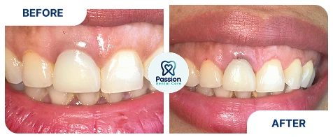 Hasil perawatan {{ result?.title }} Passion Dental Care