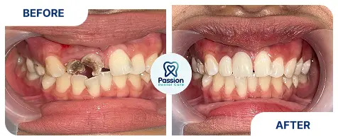 Hasil perawatan {{ result?.title }} Passion Dental Care