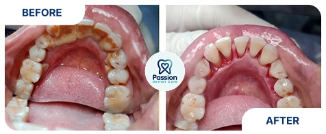 Hasil perawatan {{ result?.title }} Passion Dental Care
