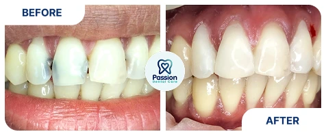 Hasil perawatan {{ result?.title }} Passion Dental Care