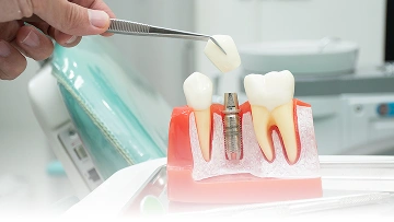 Layanan {{ result?.title }} Passion Dental Care