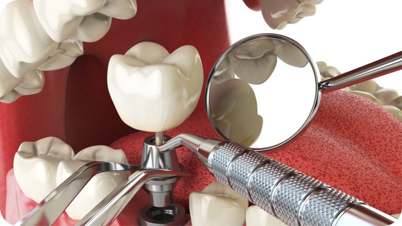pasang implan gigi | Passion Dental Care
