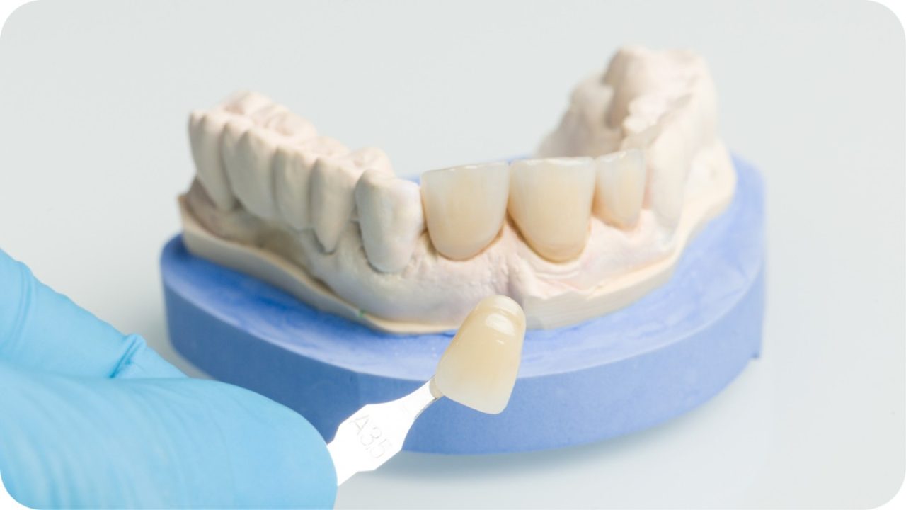 Cara memutihkan gigi veneer gigi | Passion Dental Care
