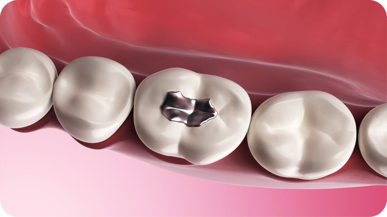 jenis tambal gigi amalgam | Passion Dental Care