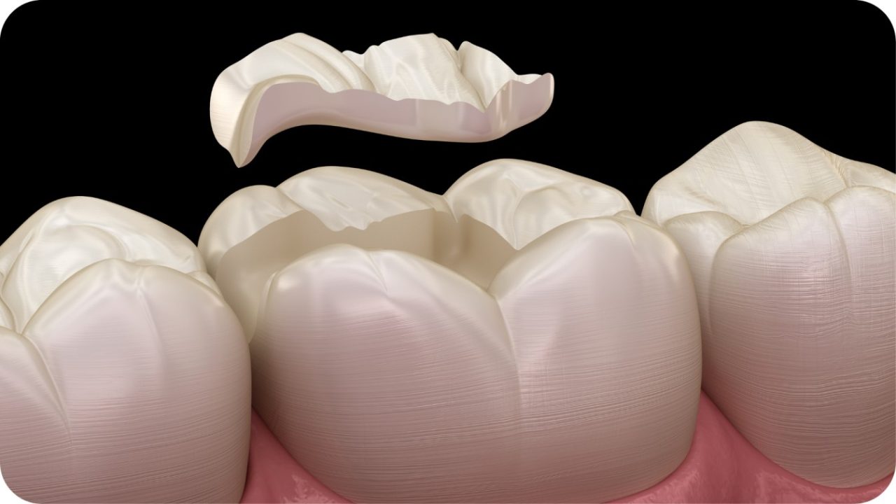 jenis tambal gigi composite | Passion Dental Care