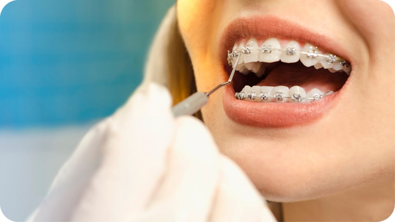 pemasangan behel damon | Passion Dental Care