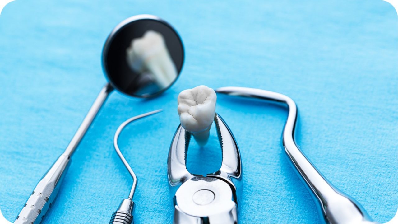 prosedur tambal gigi | Passion Dental Care