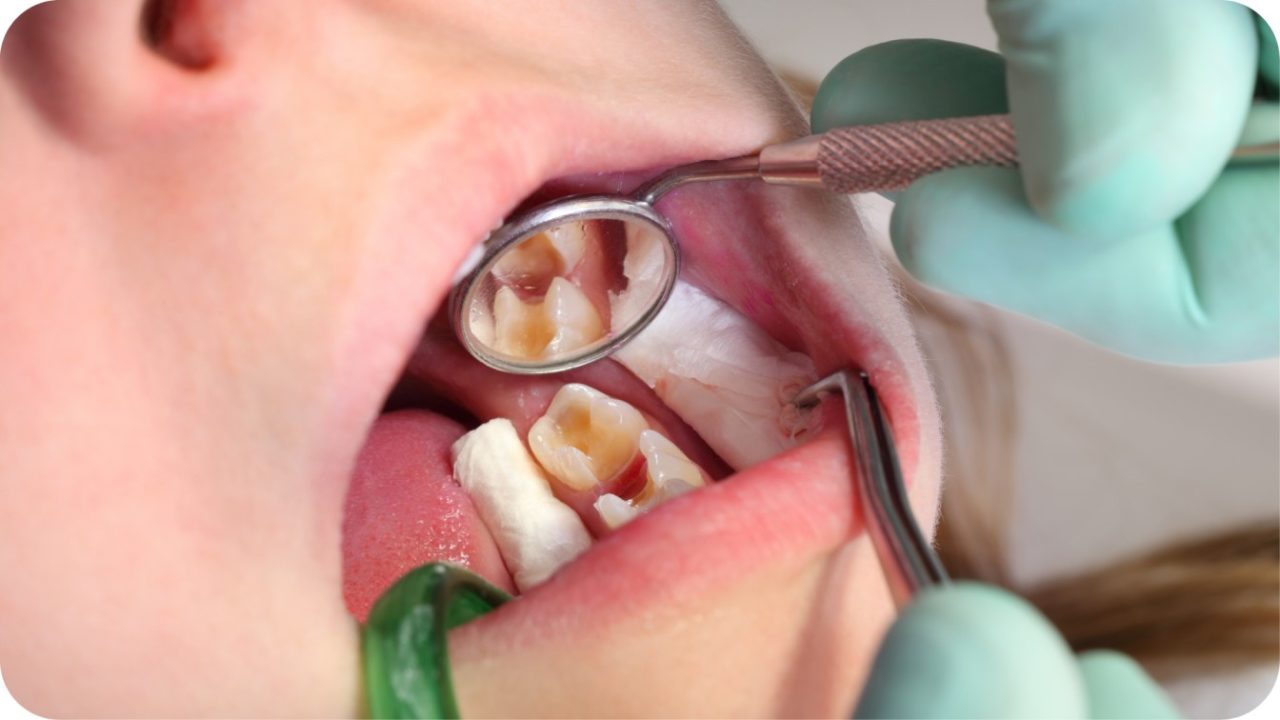 gigi berlubang | Passion Dental Care