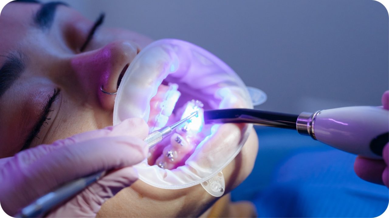 pasang behel gigi | Passion Dental Care