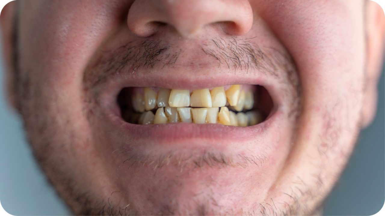 Gigi Kuning Karena Kopi | Passion Dental Care