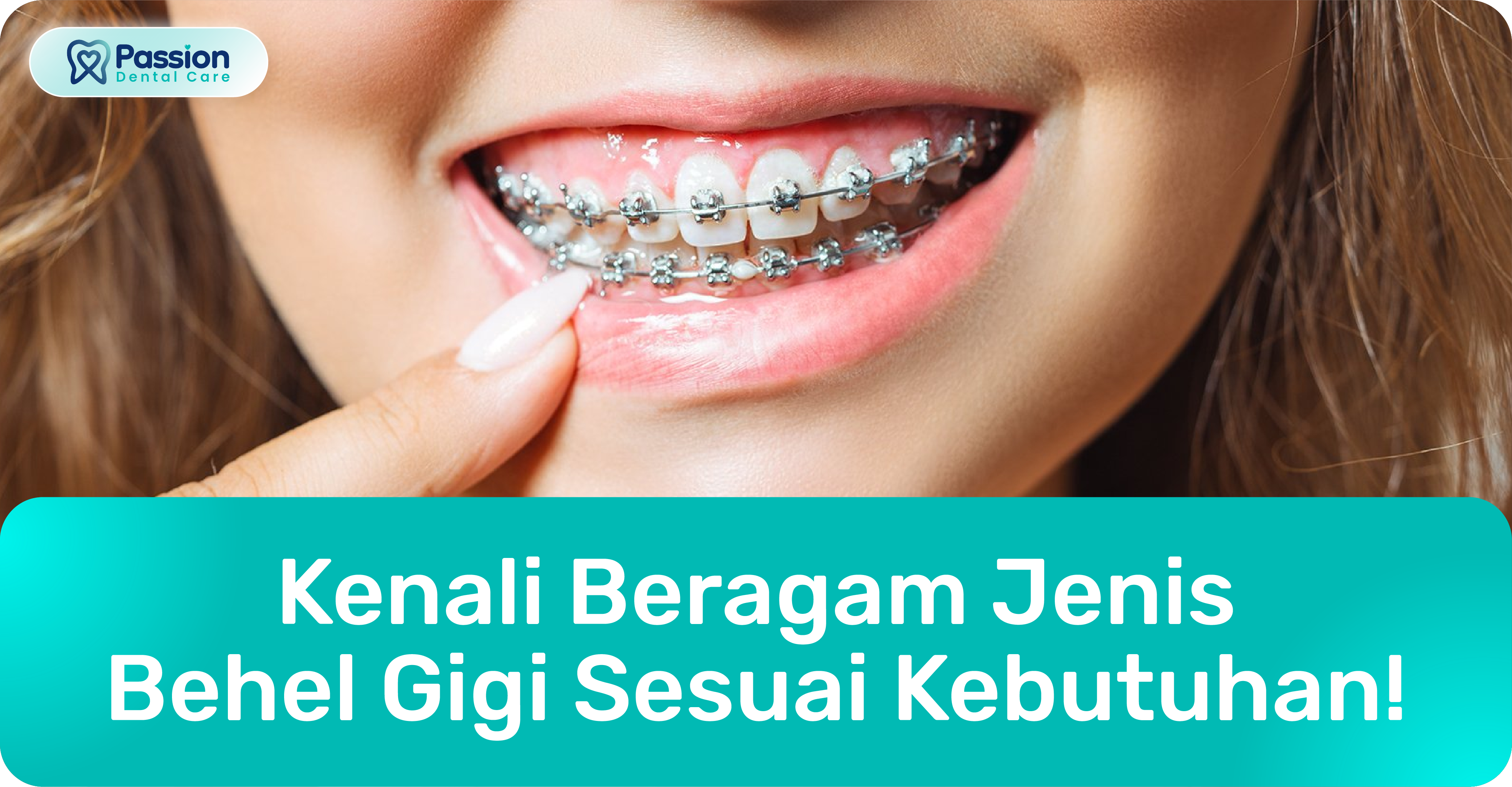 article pasang behel gigi jenis | Passion Dental Care