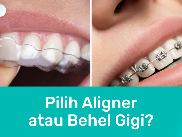 Aligner atau Behel: Mana yang Lebih Efektif untuk Merapikan Gigi?